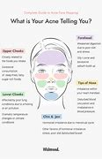 Image result for Acne On Side of Face