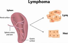 Image result for Lymphoma Panel