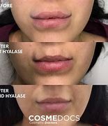 Image result for Bad Lip Fillers