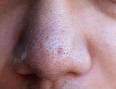 Image result for Open Nose Pores