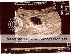 Image result for 6 Week Ultrasound Pictures