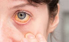 Image result for Real Yellow Eyes