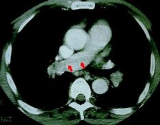 Image result for CTA Chest