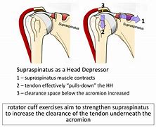 Image result for Supraspinatus and Infraspinatus Tendinopathy