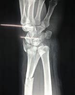 Image result for Radius Fracture