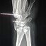 Image result for Radius Fracture