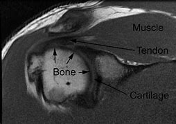 Image result for Shoulder MRI