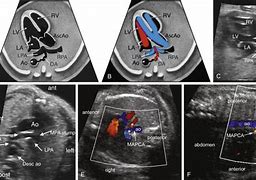 Image result for Abnormal Fetal Heart Ultrasound