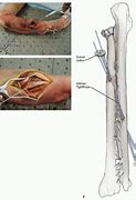 Image result for Interosseous Ligament