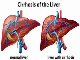 Image result for Early Symptoms Cirrhosis Liver