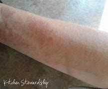 Image result for Candida Rash