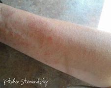 Image result for Candida Skin Rash Symptoms