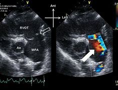 Image result for Right Ventricular Outflow Tract