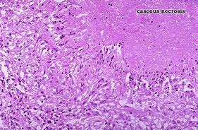 Image result for Necrosis Histology