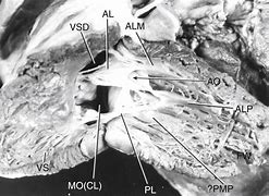 Image result for Complete Atrioventricuar Canal