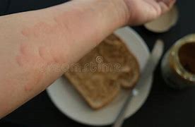 Image result for Peanut Butter Allergy Rash