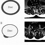 Image result for Lumbar Spine MRI 8Mm