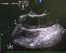 Image result for Aortic Stenosis Doppler