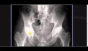 Image result for Pelvis and Hip Joint