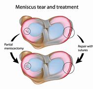 Image result for Right Knee Meniscus