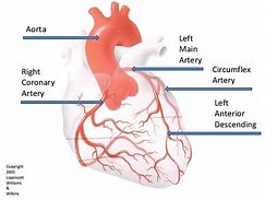 Image result for Coronary Artery Angiography