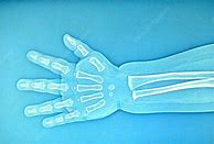 Image result for Child's Hand X-ray