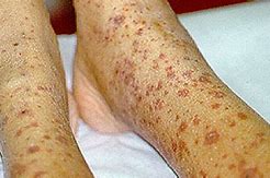 Image result for Vasculitis Signs