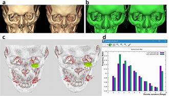 Image result for Orbital Rim Bones