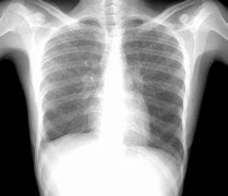 Image result for Miliary Tuberculosis Chest X-ray