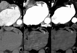 Image result for Cardiac CT Left Atrial Appendage Thrombus