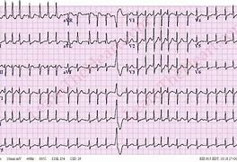 Image result for SVT vs Rapid AFib