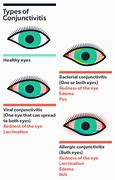 Image result for Allergic Conjunctivitis Treatment