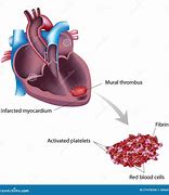 Image result for What Is a Thrombus