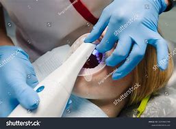 Image result for 3D Teeth Scanner