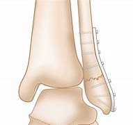 Image result for Area Distal to Lateral Malleolus