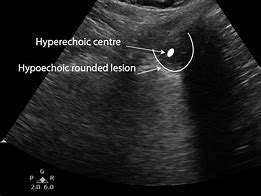 Image result for Pulmonary Regurg Ultrasound Flame