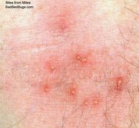 Image result for Skin Mites On Humans