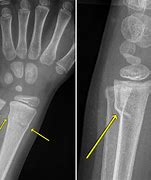 Image result for Radius Fracture