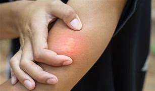 Image result for Bug Bites and Stings