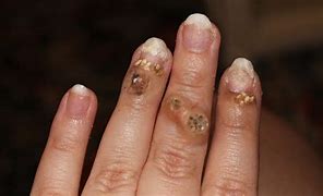 Image result for Filiform Wart On Finger