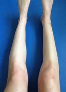 Image result for Calf Muscle Atrophy