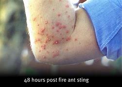 Image result for red ants bites