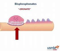 Image result for Bisphosphonate Injection