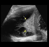 Image result for Thoracic Empyema On Percussion