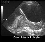 Image result for Distended Bladder