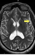 Image result for Seizure On MRI