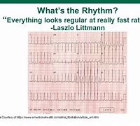 Image result for SVT vs Rapid AFib