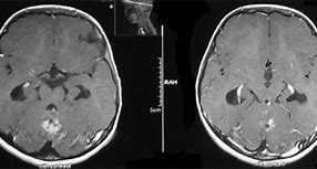 Image result for Neuropil Medulloblastoma