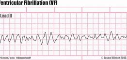 Image result for Ventricular Fibrillation EKG Examples