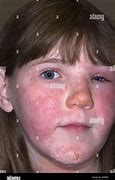 Image result for Poison Ivy Rash Face